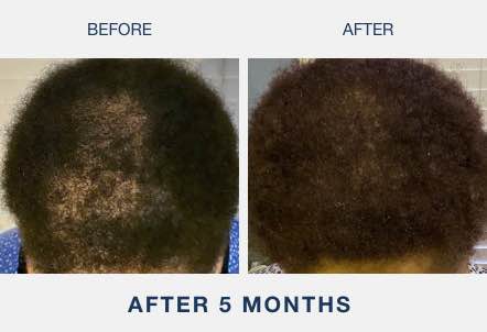 african american woman before and after results from illumiflow laser caps