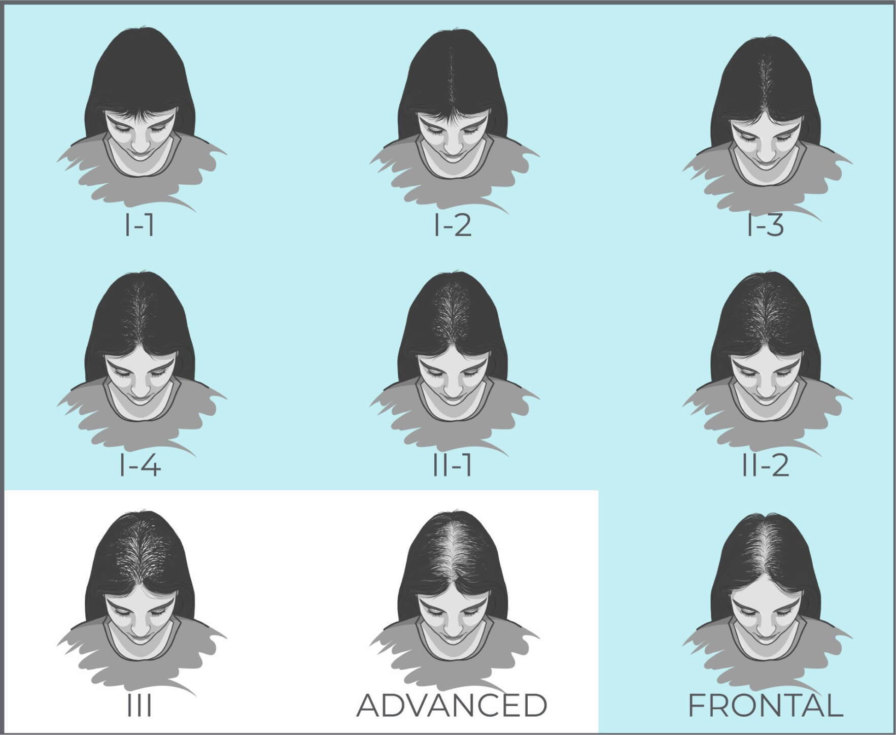 Women Hair Loss Pattern