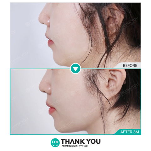 Ulthera Prime and InMode FX Jawline Lifting Before and After 3 Months – Non-Surgical Face Lift in Korea by Jivaka Beauty