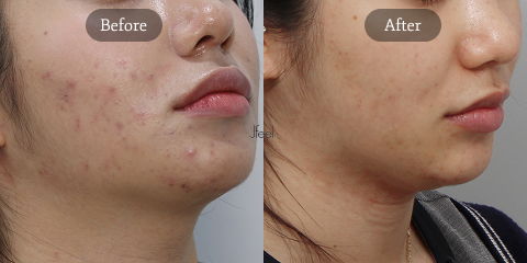 Exosome Therapy and Rejuran PDRN Injection for Acne Scar Treatment and Long-Term Skin Regeneration in Korea