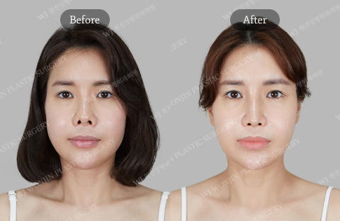Revision rhinoplasty improving overall facial balance and creating a more natural looking result in Korea