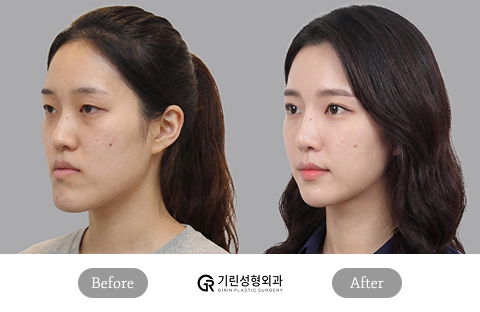 Plastic Surgery Recovery Timeline Weeks 2 to 12 Showing Visible Healing Progress and Gradual Results Development