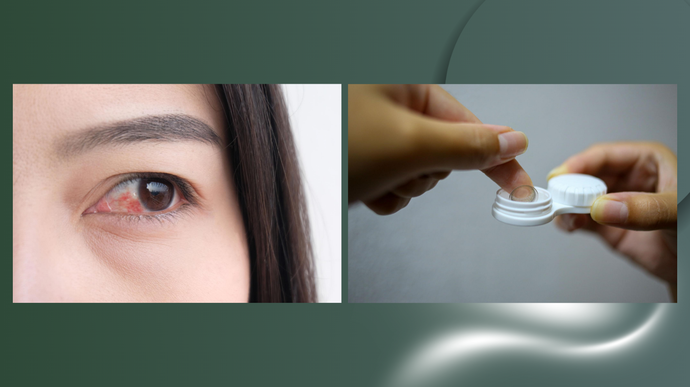 Close-up of red irritated eye with contact lens being placed into a contact lens case, highlighting eye discomfort, lens removal, and proper contact lens hygiene and care routine