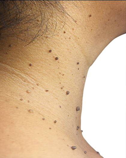 A picture of skin tags on thhe neck