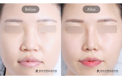 Revision rhinoplasty combining hump nose correction, nasal tip refinement, and alar reduction showing balanced front view result at 3 months in Korea