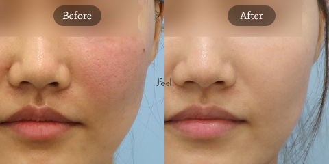 Rejuran Healer and Exosome Therapy for Sensitive Skin Repair and Glass Skin Treatment in Seoul