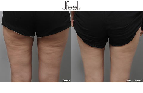 Noninvasive Liposuction Thigh Body Fat Reduction Before and After Results After 4 Weeks