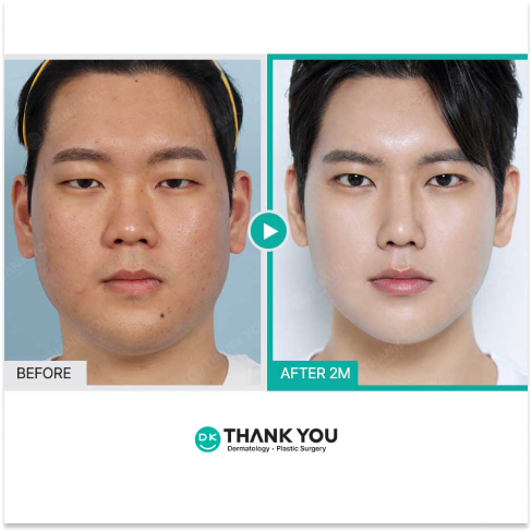 Jawline Contouring Korea for Stronger Masculine Definition and Natural Facial Balance in Male Plastic Surgery