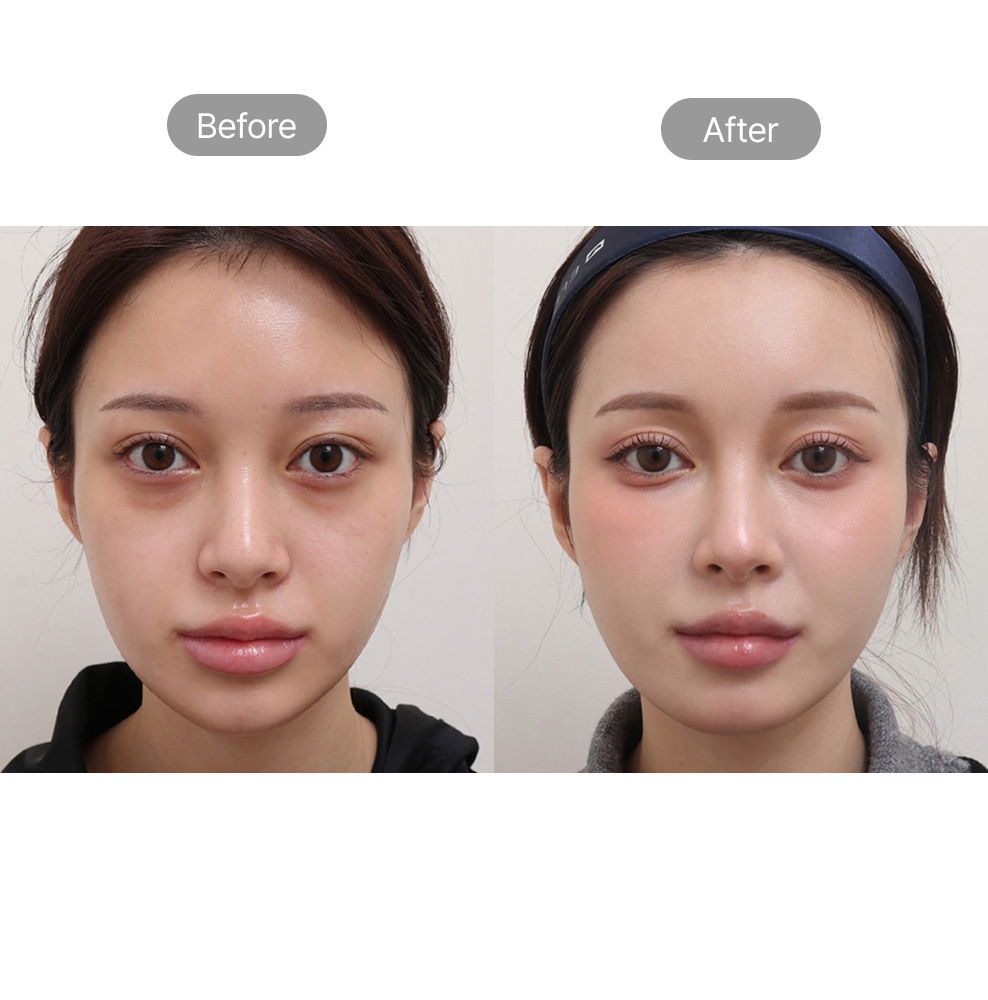 Facial volume restoration before and after results at Fresh Dr. Hong Plastic Surgery in Korea