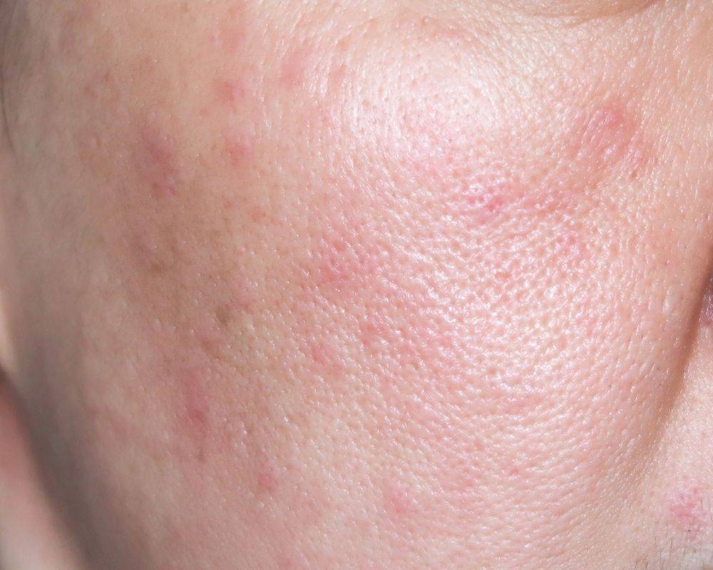 Closeup of client's face with red, irritated skin