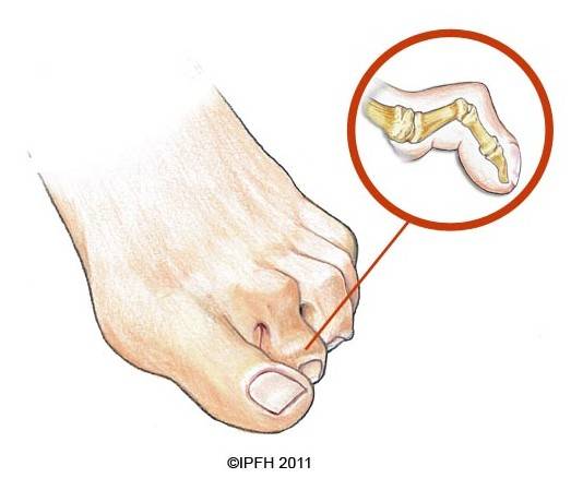 What Is A Hammertoe? Premier Foot & Ankle Center