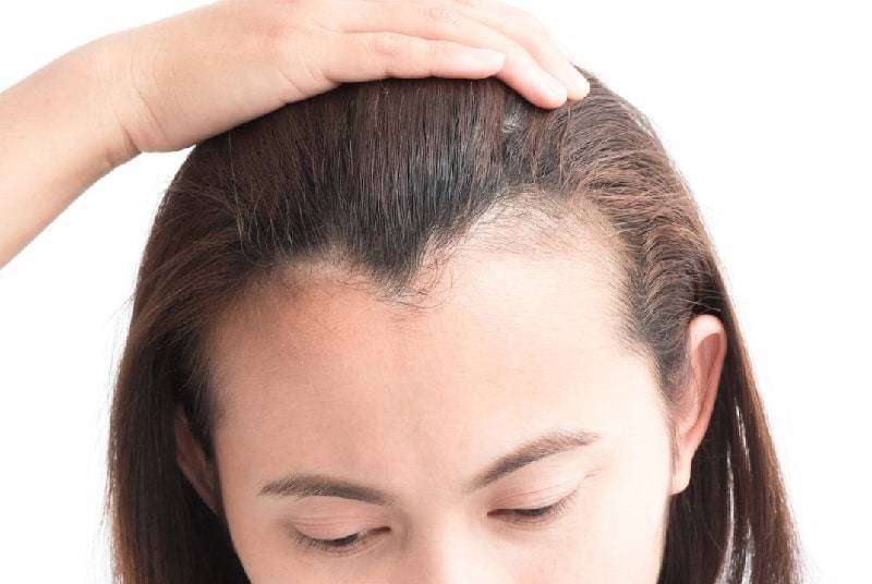 Girl receding hairline Hairstyles for