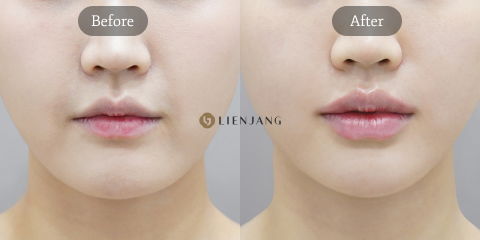 Korean lip augmentation before and after treatment demonstrating fuller lips and balanced facial harmony