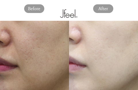 Before and After Pico Fraxel Laser Treatment for Face and Pigmentation Treatment on Face at Jfeel Clinic Korea