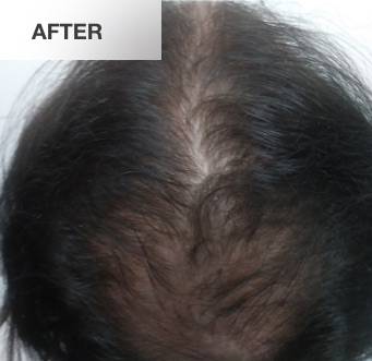 image of mens hair regrowth after lllt