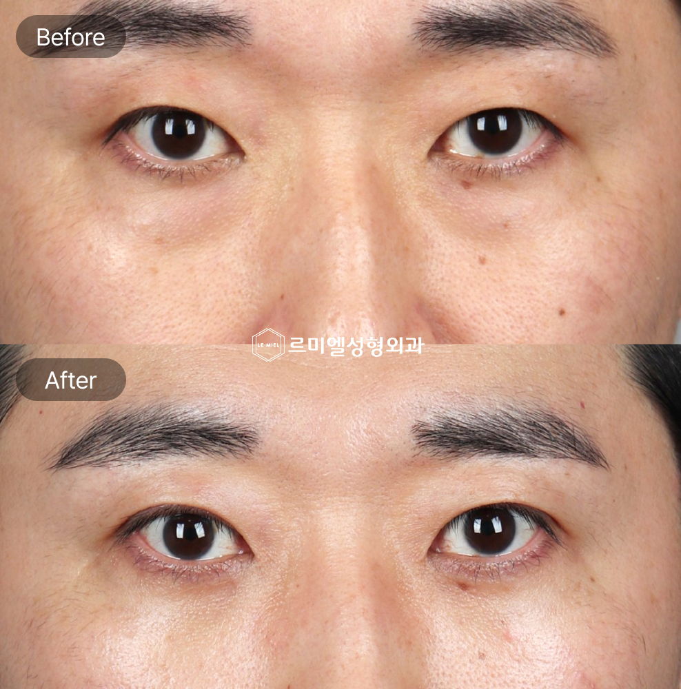 Before and After Results of Under Eye Fat Repositioning, Virtue RF Treatment, and Non Incisional Ptosis Correction After One Month