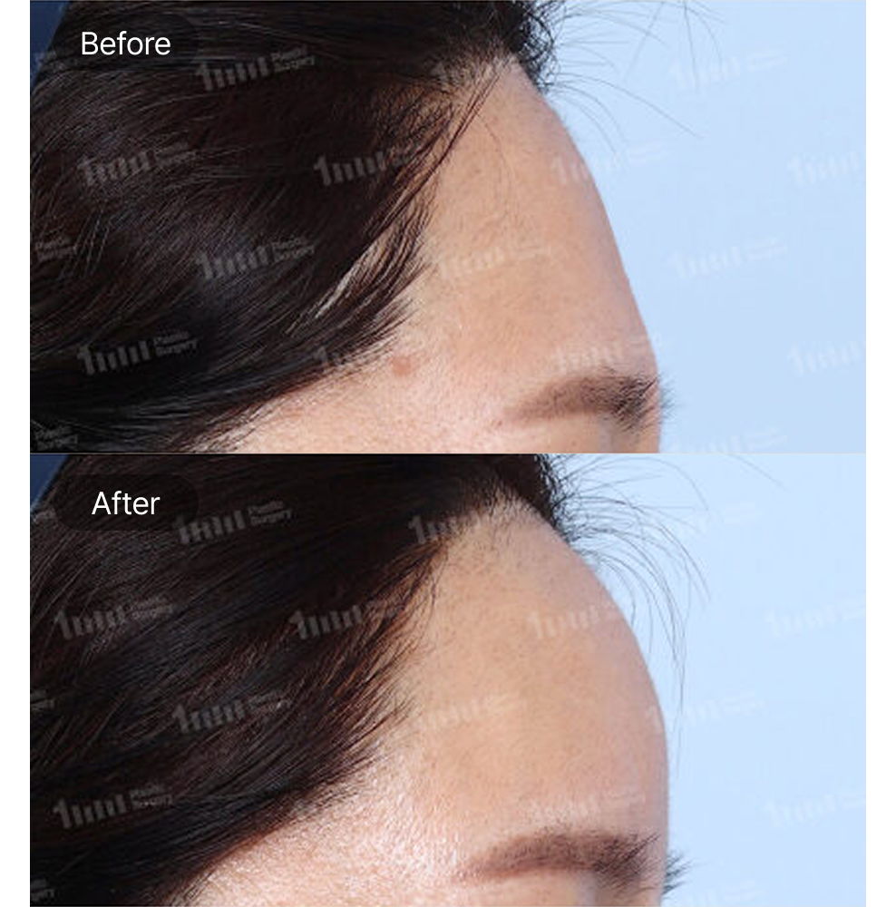 Forehead Filler Before and After Results at 1MM Plastic Surgery in Korea for a Smoother and Fuller Forehead Contour