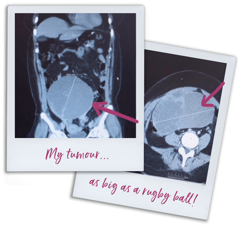 X-ray showing Emma's ovarian cancer tumour prior to surgery