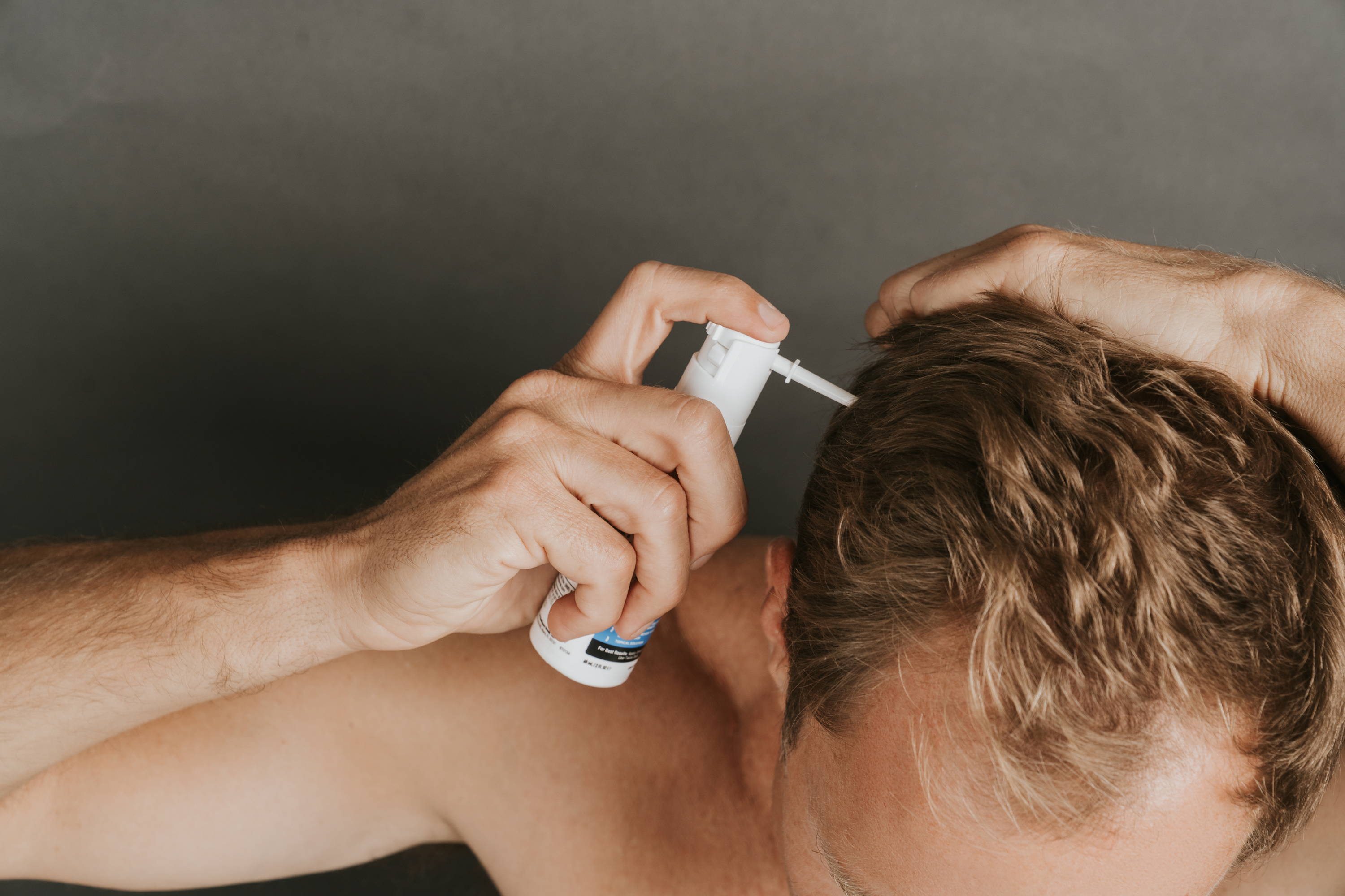 Does Minoxidil For Hair Loss Cause Dandruff? – DS Healthcare Group