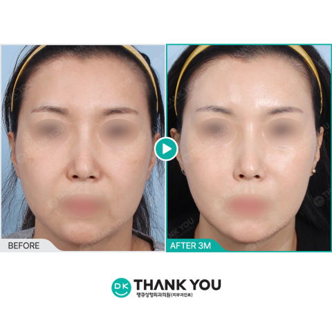 Before and after results showing skin rejuvenation with Rejuran Healer and Juvelook as a Korean filler alternative in Seoul clinics