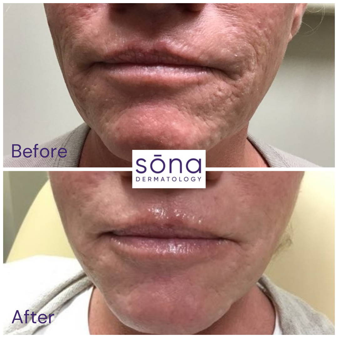 Sona SkinPen Before & After 3