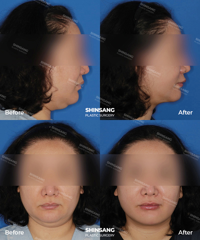 Chin Fixation And Jawline Contouring Result Review At Sinsang Plastic Surgery In Korea