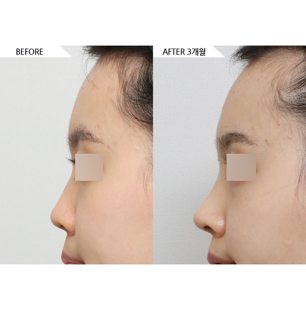 Before and after results of natural rhinoplasty showing refined nose profile and smoother facial contour in Korea