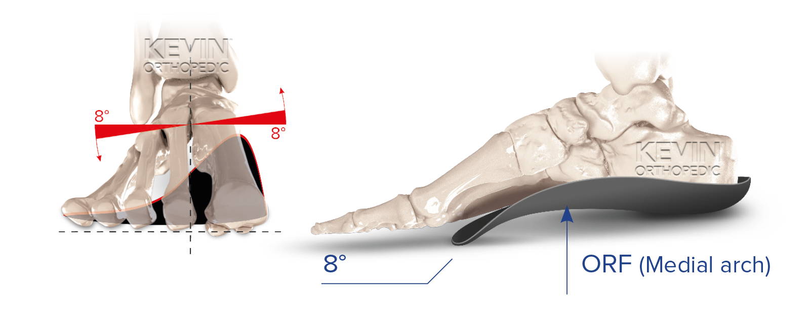 THE CLINIC GUIDE: OFFLOADING - Metatarsal Punch – Kevin Orthopedic ...