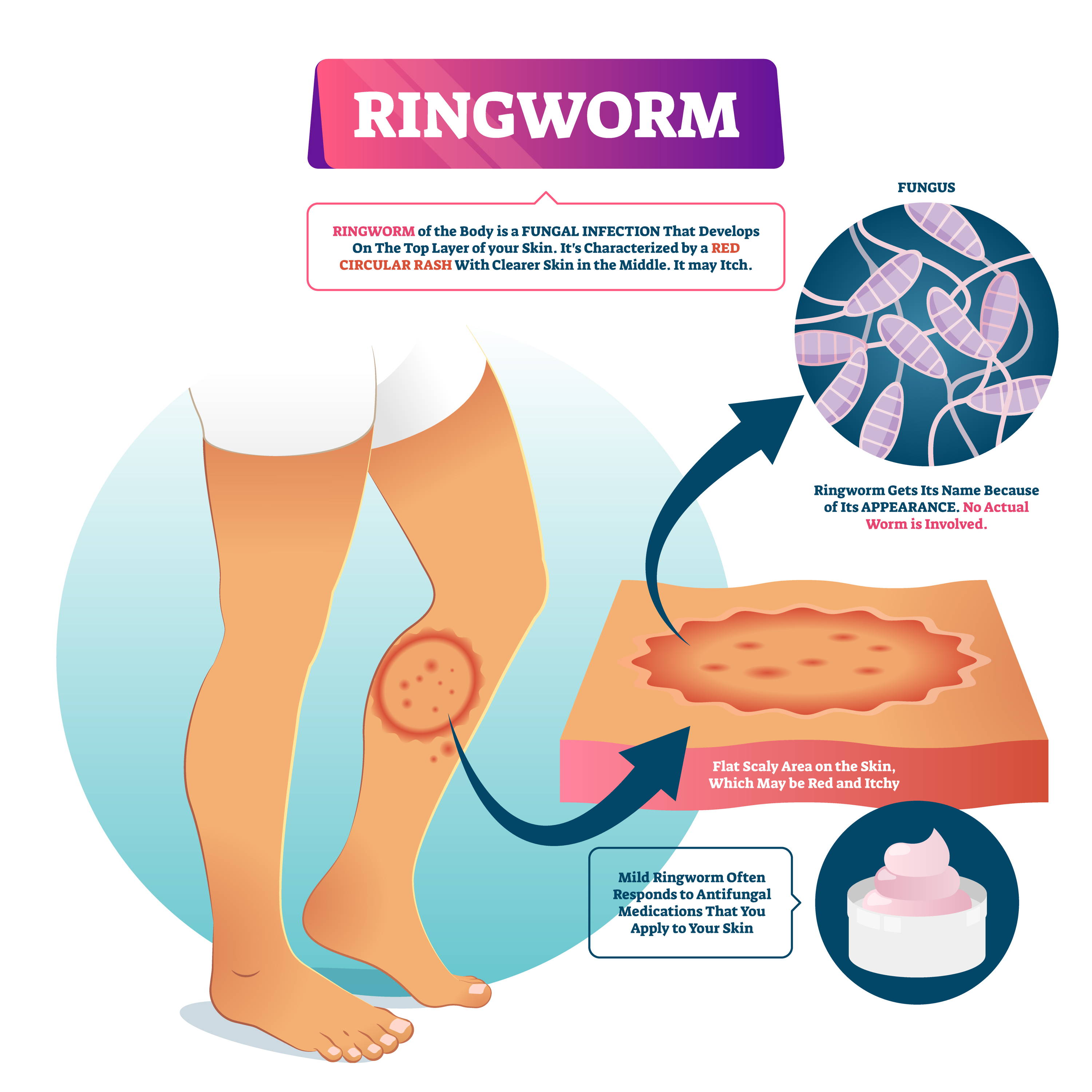 Picture of an infographic on ringworm