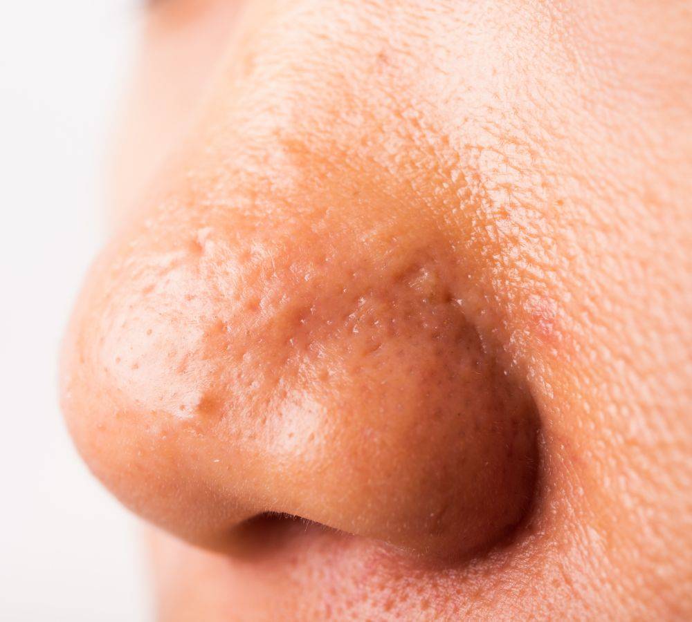 Closeup of nose