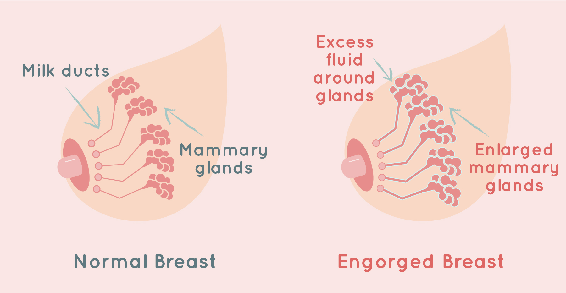 Breastmilk oversupply & breast engorgement