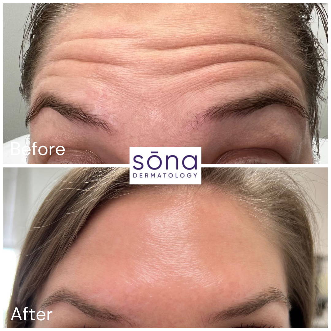 Sona - Botox Cosmetic Before & After 10