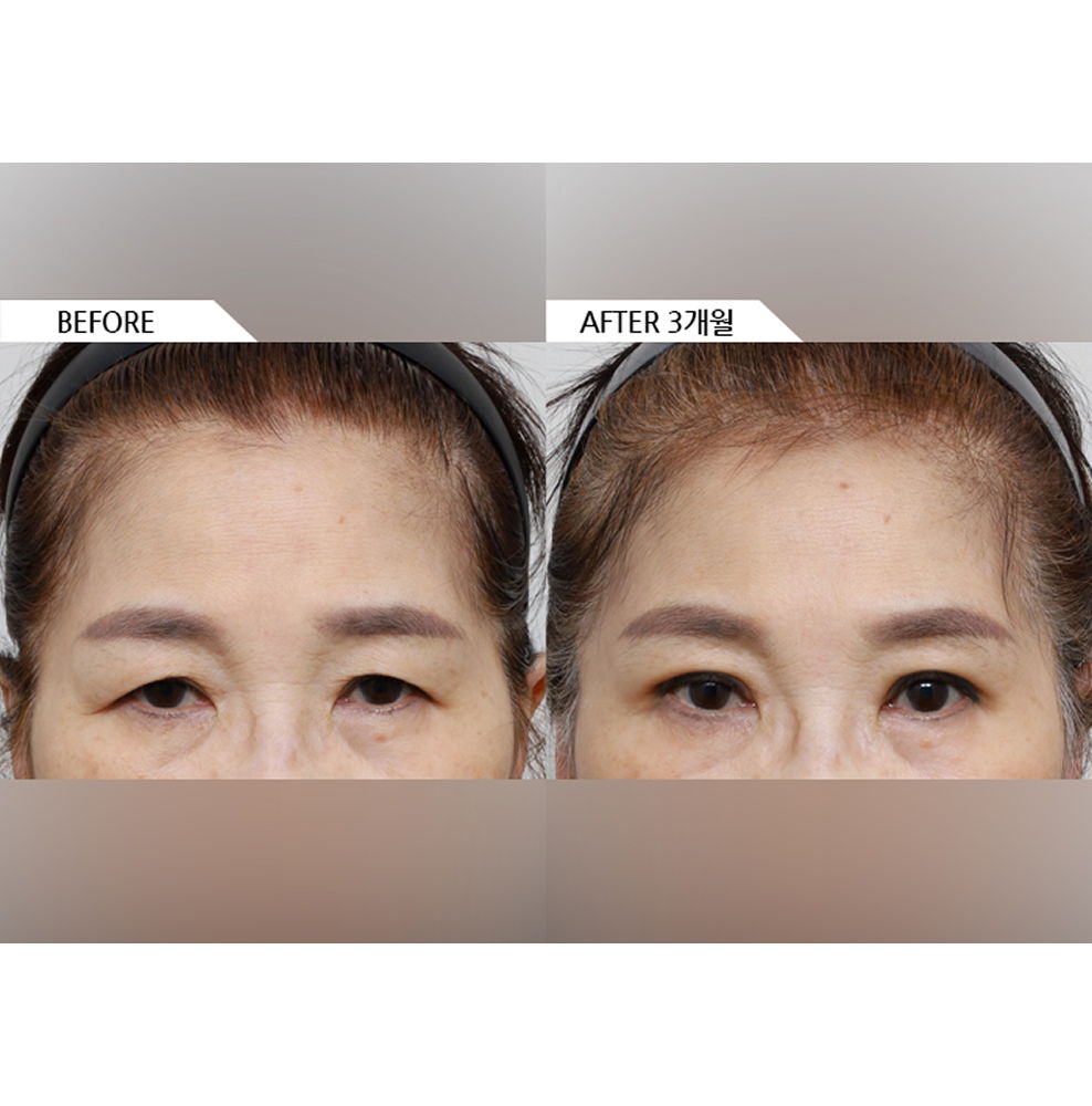 Before and after results of upper eyelid surgery, ptosis correction, and forehead lift showing improved eye openness and youthful appearance in Korea