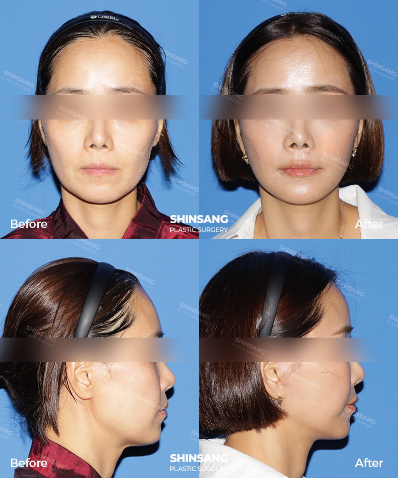 Mini Facelift With Full Face Fat Grafting Result At Sinsang Plastic Surgery In Korea