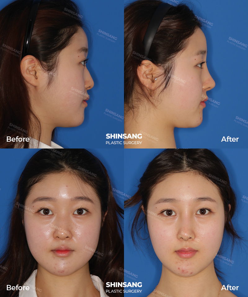 Nose Bridge Augmentation And Nose Tip Surgery Before And After Result At Sinsang Plastic Surgery In Korea