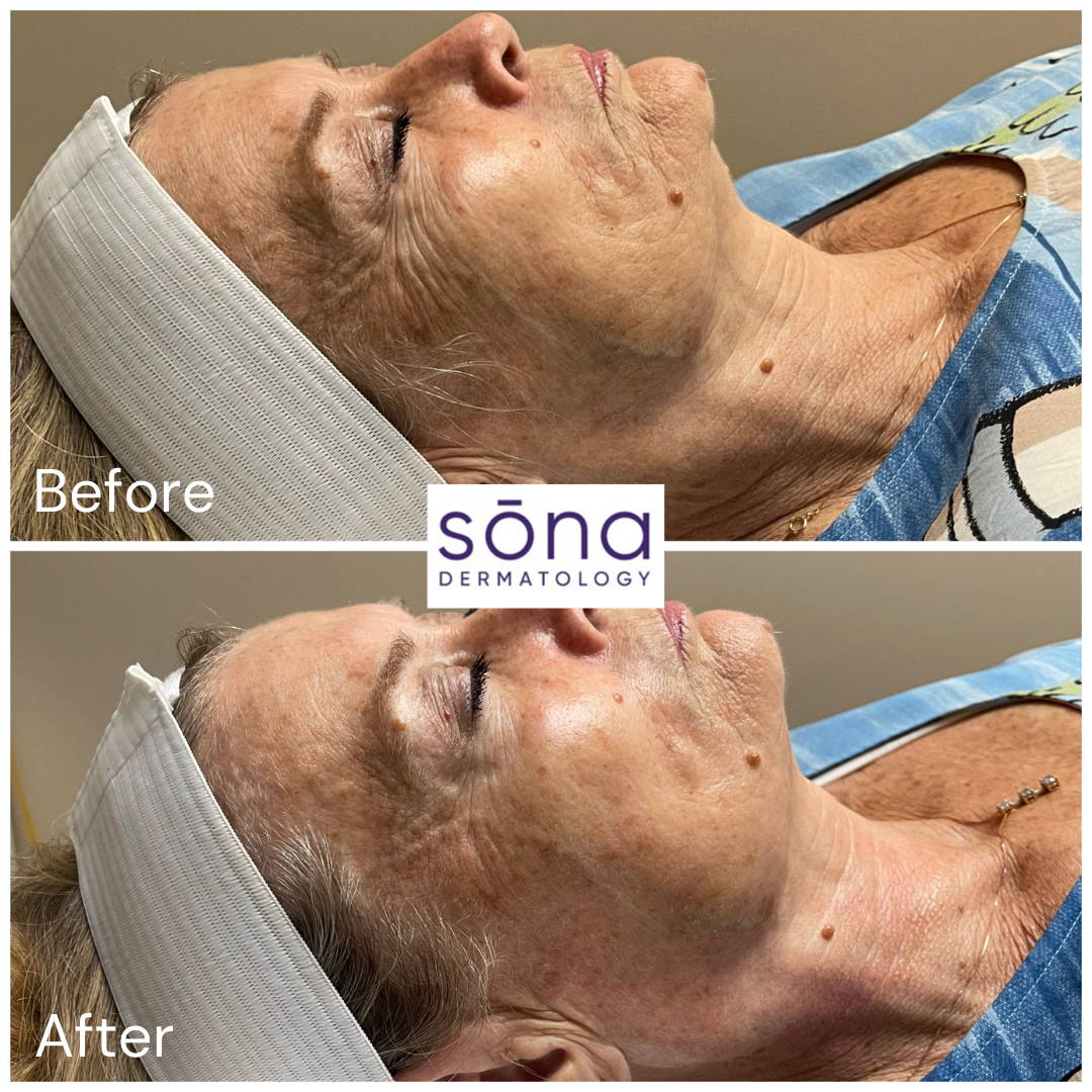 Sona DiamondGlow Facial Before & After 4