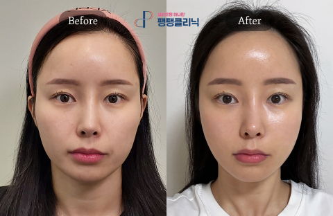 Midface Thread Lift Before and After in Korea Showing Nasolabial Fold Reduction, Improved Facial Firmness, and Youthful Facial Rejuvenation