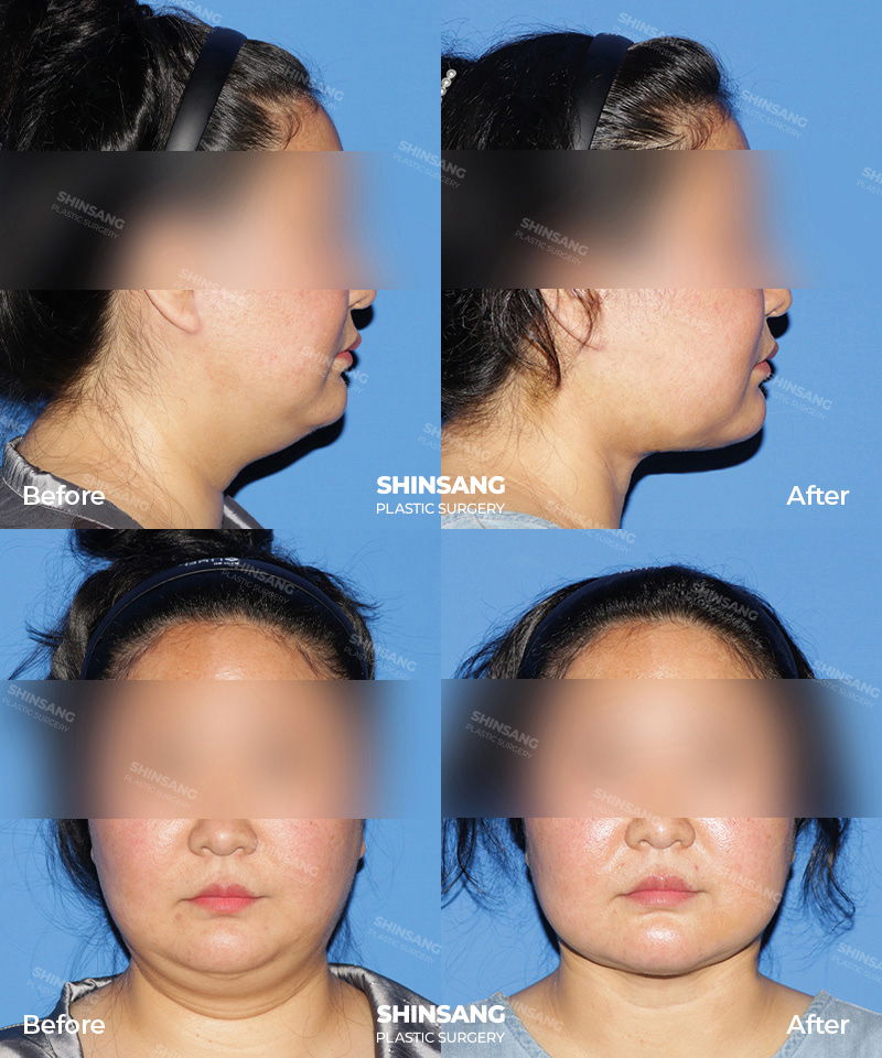Toad Neck Surgery And Neck Reduction Before And After Result At Sinsang Plastic Surgery In Korea