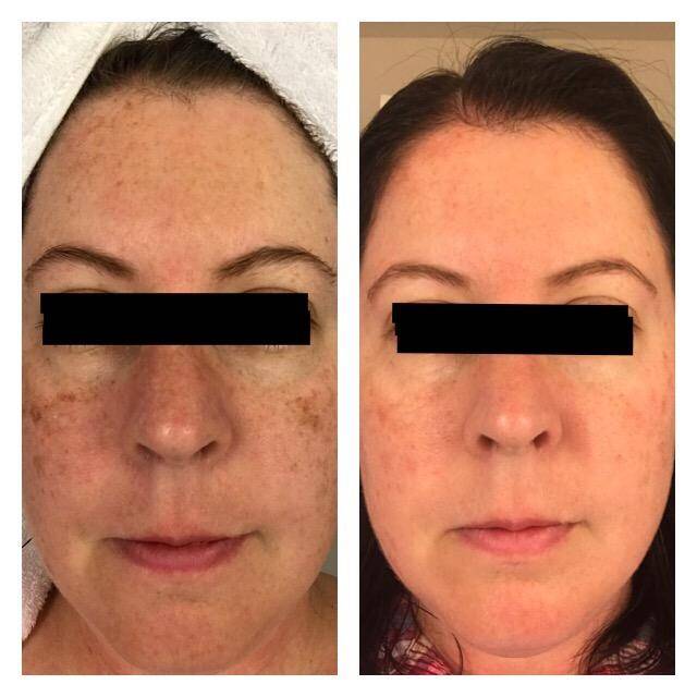 admire my skin melasma