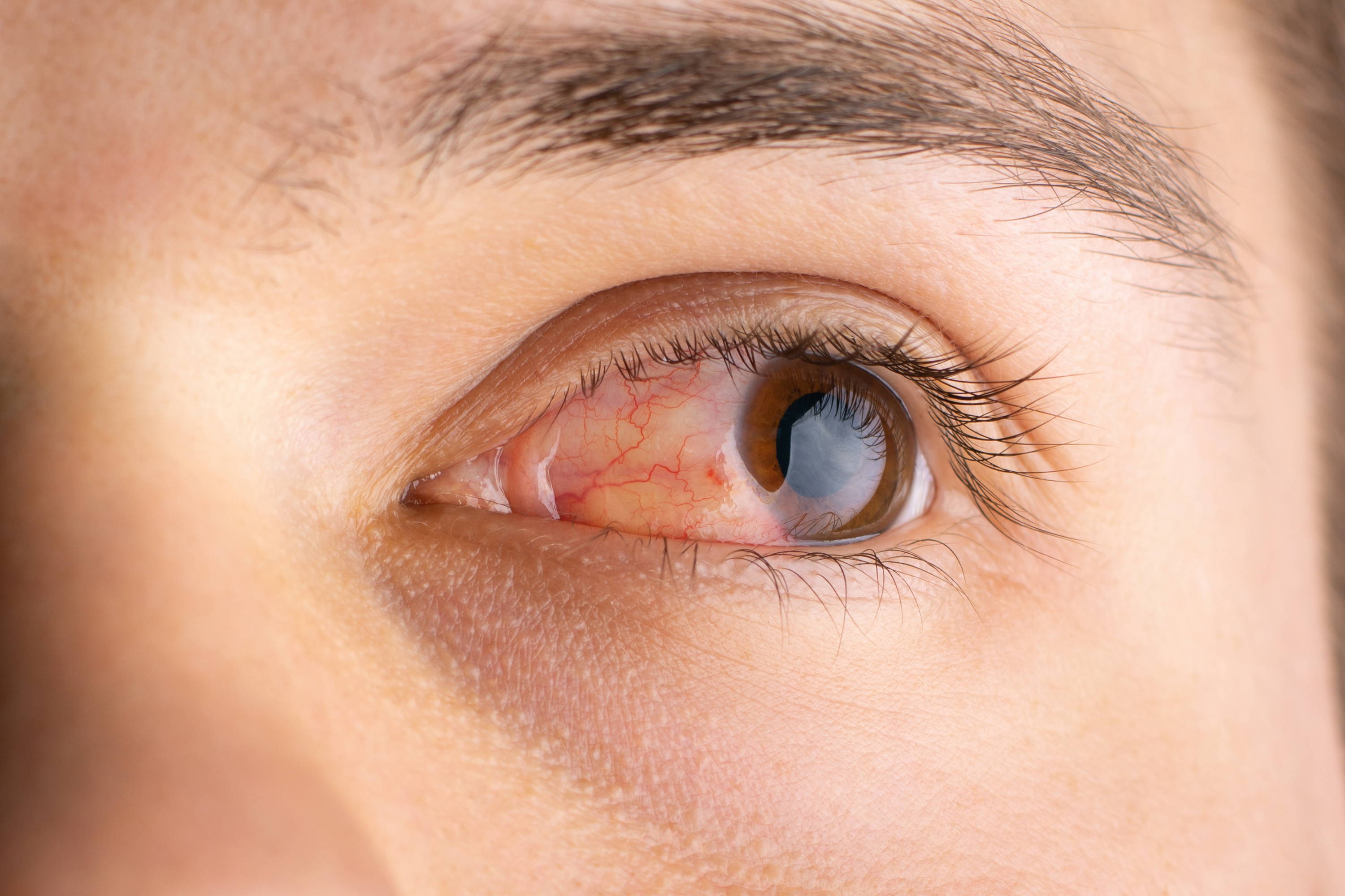  Nærbilde som viser at øyets hvite område er rødt/irritert.
