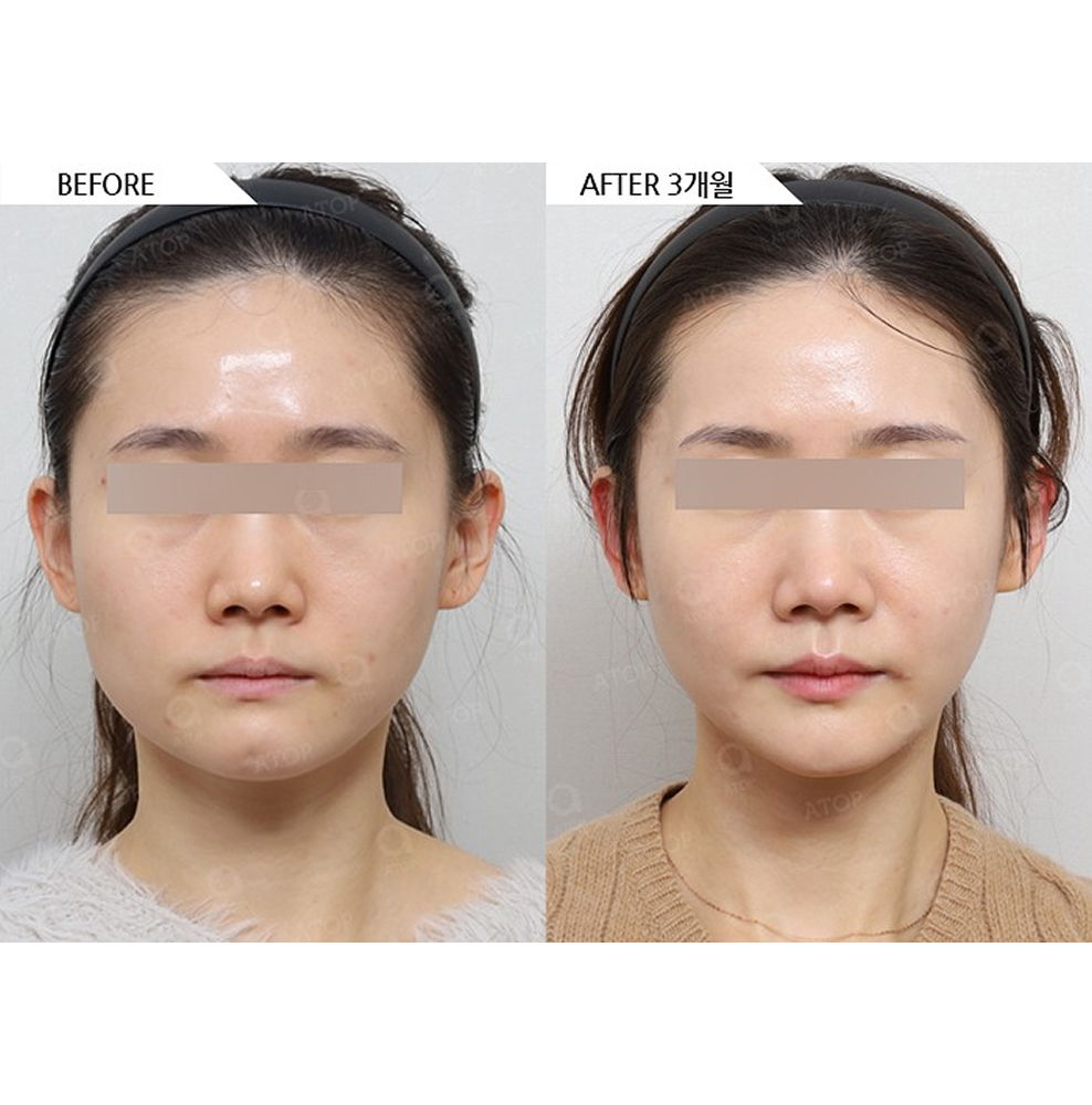 Before and after results of zygoma reduction and square jaw contouring showing a slimmer face shape and improved facial balance in Korea