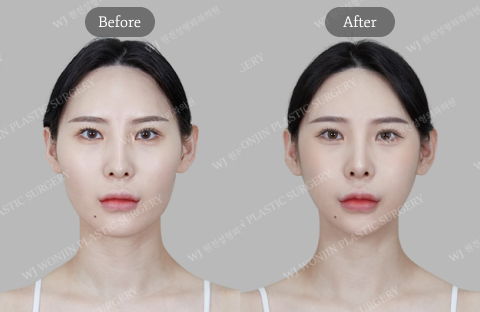 Plastic Surgery Recovery Timeline Showing Final Results After Full Healing and Long Term Outcome