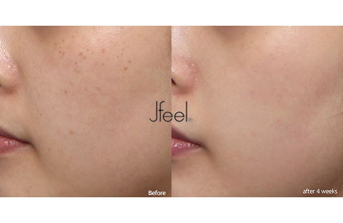 Before and After 4 Weeks of Pico Toning Laser Treatment for Face and Pigmentation Treatment on Face at Jfeel Clinic Korea