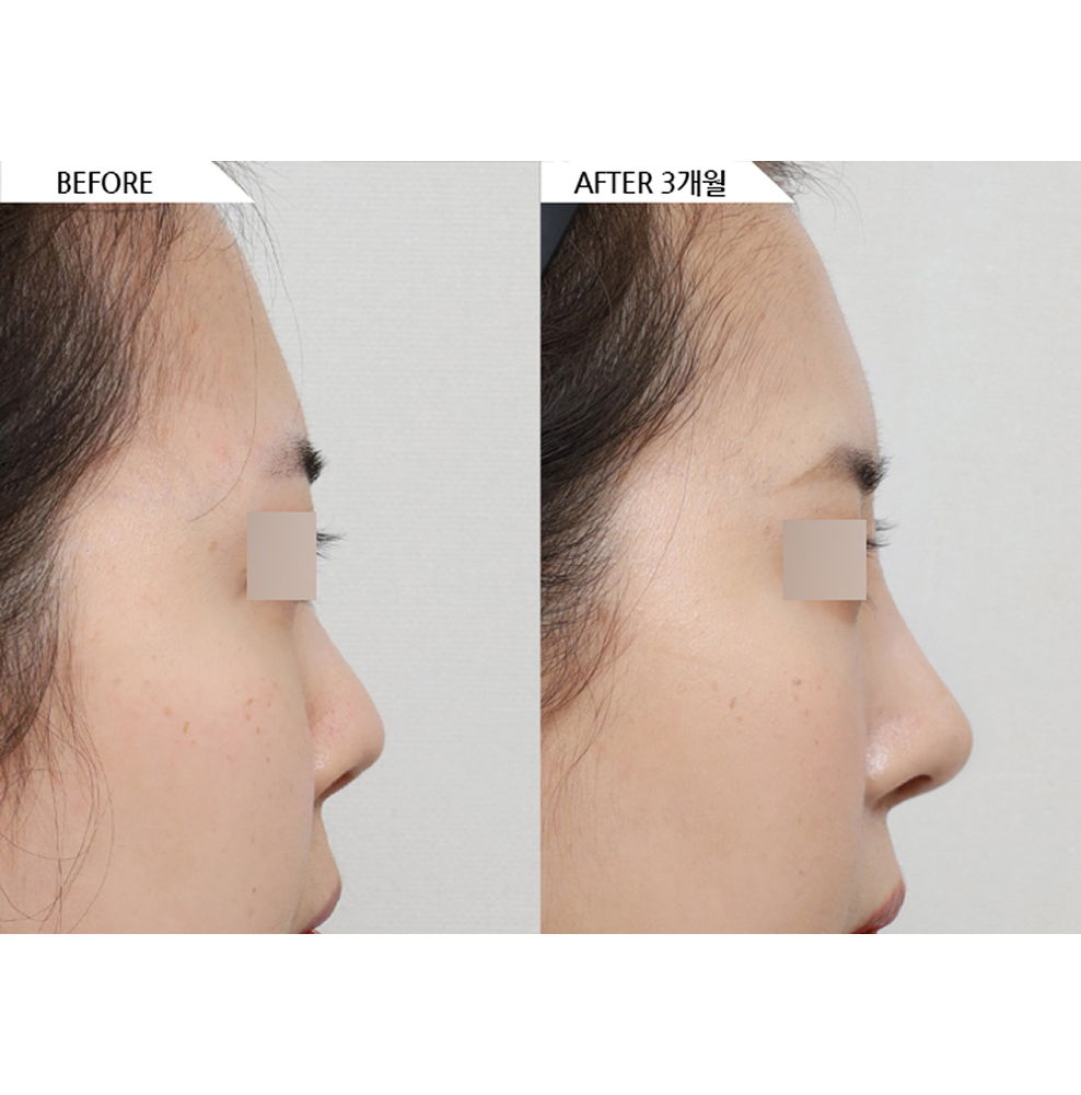 Before and after results of rhinoplasty including nose bridge augmentation, tip refinement, bulbous nose correction, and functional nose surgery for a balanced and natural profile in Korea