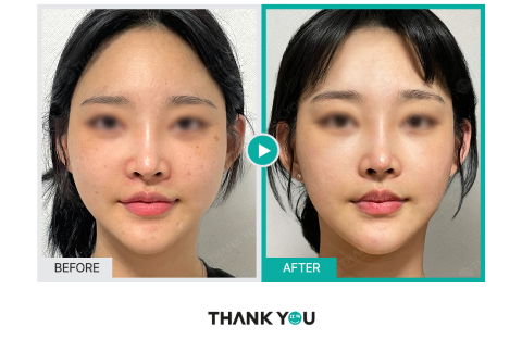 Before And After Review Image Of Rejuran Healer Treatment At Thank You Plastic Surgery Clinic In South Korea
