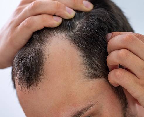 Hair loss treatment for men and women