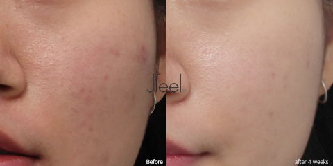 Acne Laser and Aquapeel Treatment Before and After for Clearer Skin