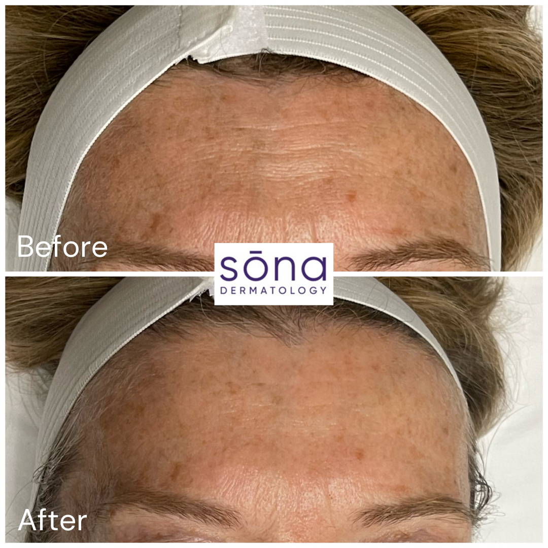 Sona DiamondGlow Facial Before & After 6
