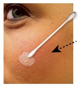 Comment EMUAID agit pour éliminer votre acné