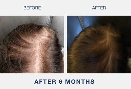 before and after laser cap results of a white woman regrowing hair at the part